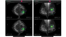 Mammography images side-by-side with and without AI to detect breast cancer